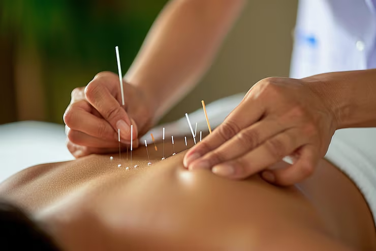 Acupuncture Services